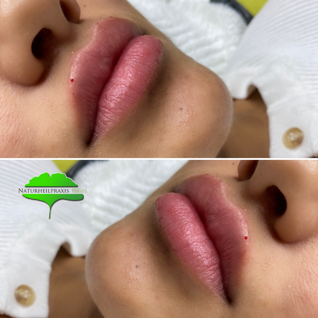 Vorher- Nachher Lippenunterspritzung